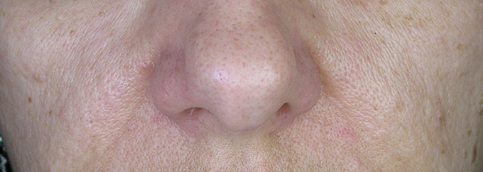 Anti-age after
