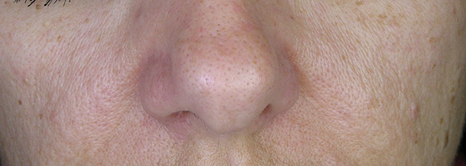 Anti-age before