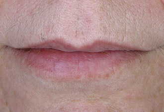 Smoking wrinkles after