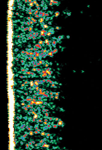 Ultrasound picture of dermis density after