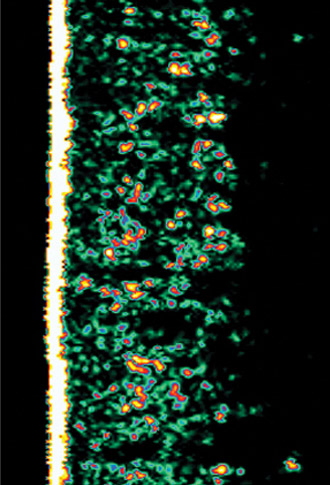 Ultrasound picture of dermis density