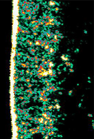 Ultrasound picture of dermis density after