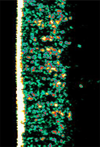 Ultrasound picture of dermis density